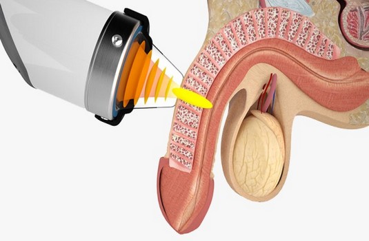 Erectile Dysfunction Surgery in India Cost Hospitals Doctor